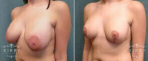 breast-lift-revision-56b-left-kirby