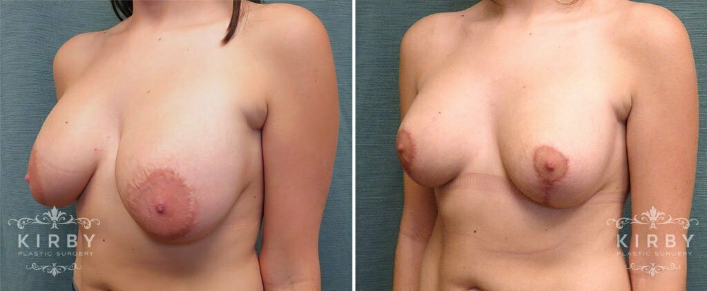 breast-lift-revision-56b-left-kirby