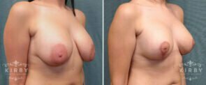 breast-lift-revision-56b-right-kirby