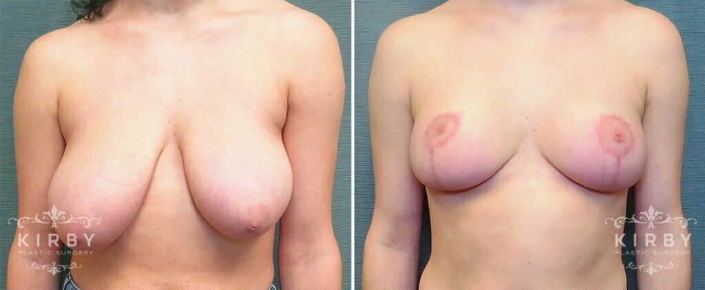 Breast Reduction G1177