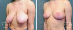 breast-reduction-177b-left-kirby