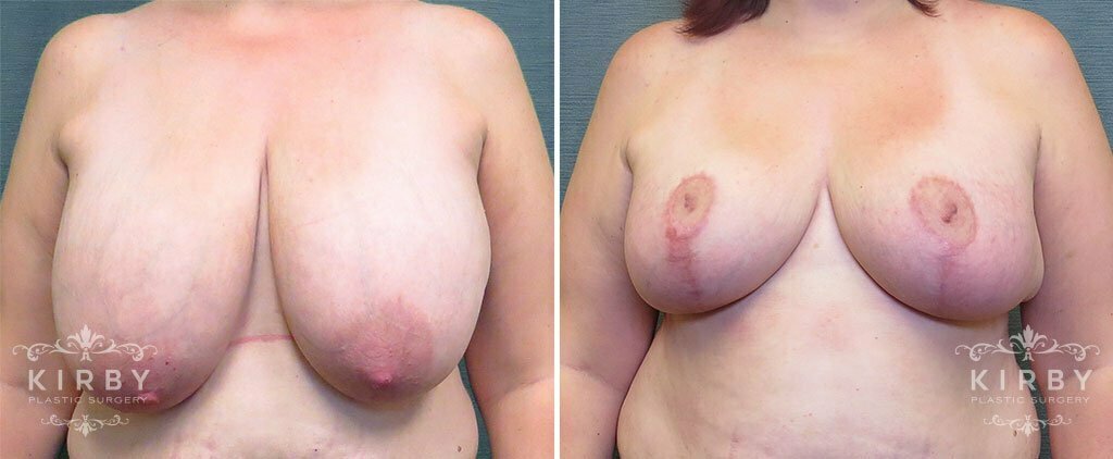 Breast Reduction G1190
