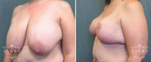 breast-reduction-190b-left-kirby