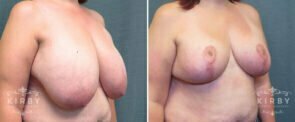 breast-reduction-190b-right-kirby