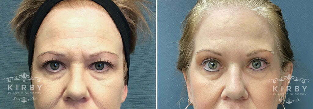 Brow Lift and Upper Eyelid Lift # G1714