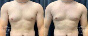 Male Breast Reduction G1743