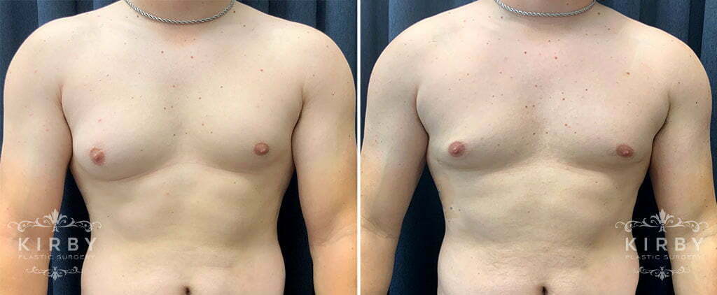 Dr. Emily Kirby's male breast reduction patient presented with gynecomastia, or enlarged male breasts, and these photos show his chest before and after the surgery