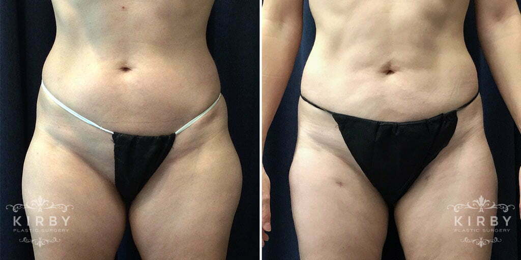 liposuction-656a-kirby