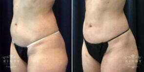 liposuction-656b-right-kirby