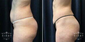 liposuction-656c-kirby