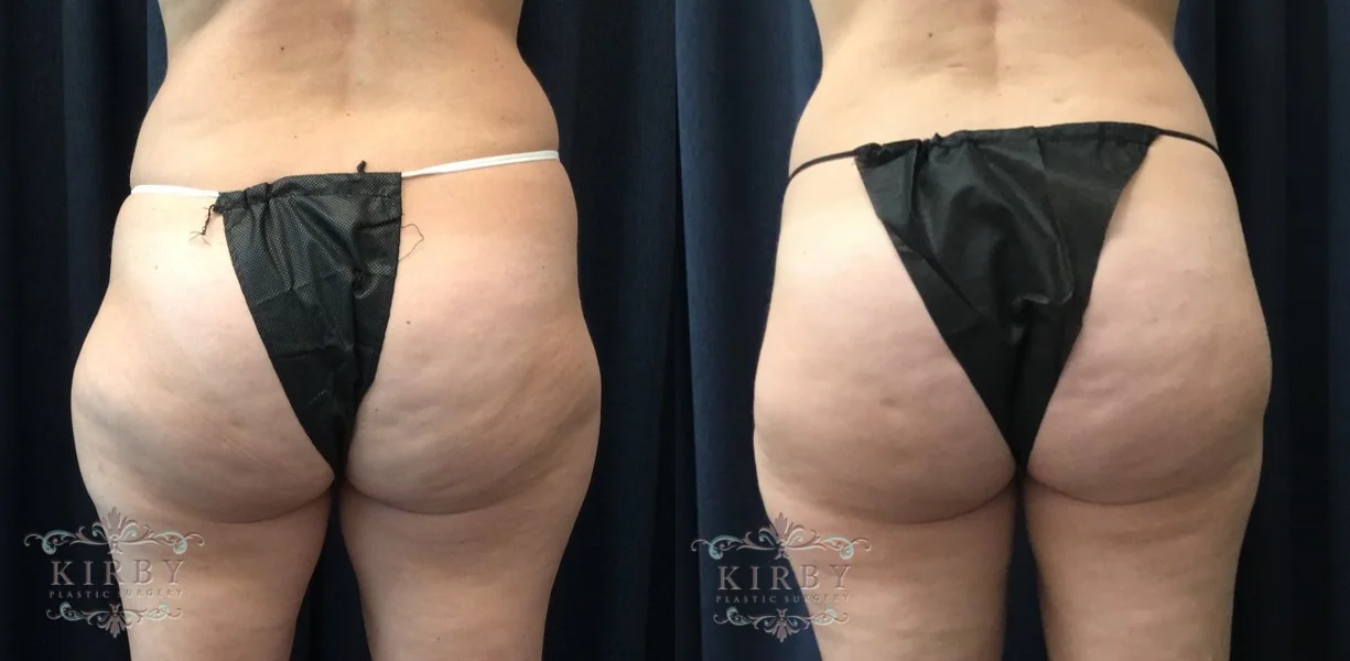 This liposuction patient of female plastic surgeon Dr. Emily Kirby had liposuction to the back (flanks, or love handles) and hips, creating a more hourglass shaped figure and natural-looking results.
