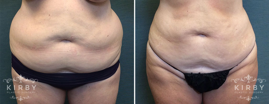 liposuction-pal-bbl-304-a-kirby