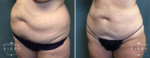 liposuction-pal-bbl-304-b-right-kirby