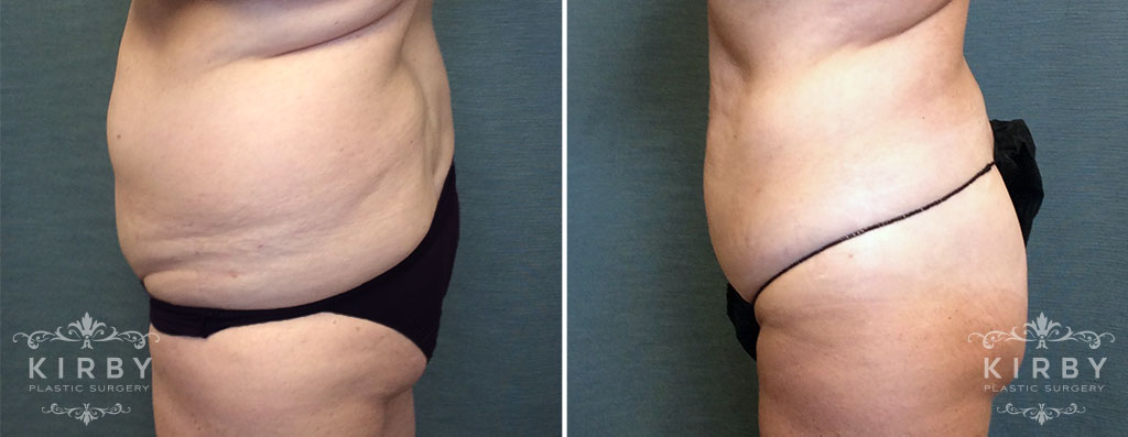 liposuction-pal-bbl-304-c-right-kirby