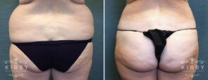 liposuction-pal-bbl-304-d-kirby