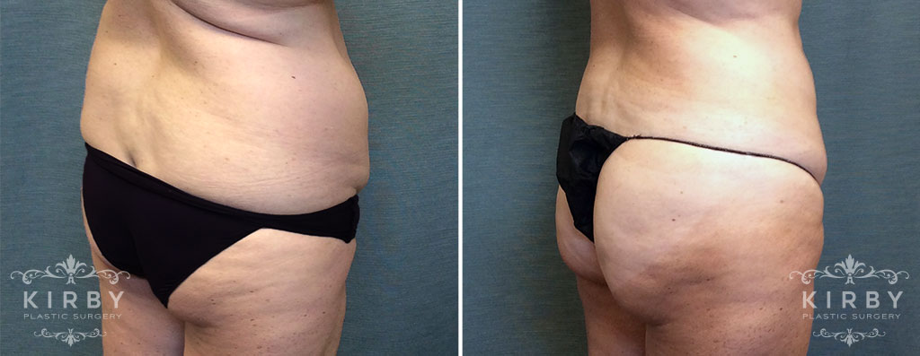 Brazilian Butt Lift G1304