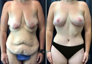 mmo-extended-abdominoplasty-breast-lift-thigh-lift-liposuction-754a-kirby