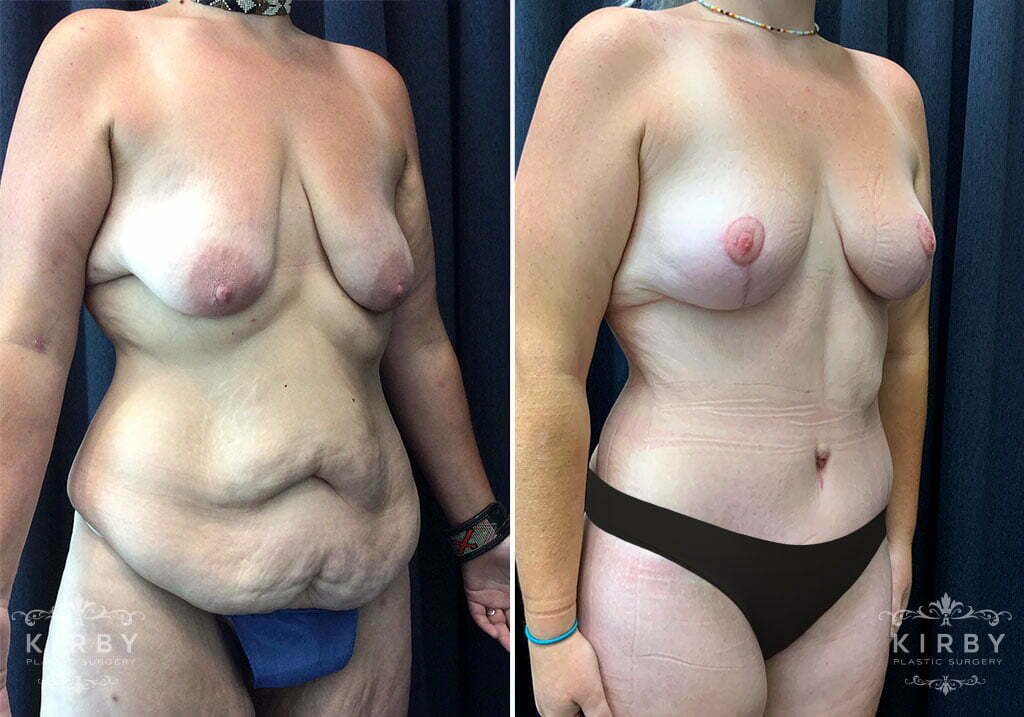 mmo-extended-abdominoplasty-breast-lift-thigh-lift-liposuction-754b-kirby