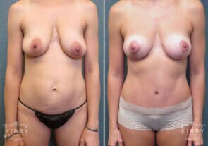 mommy-makeover-breast-lift-58a-kirby