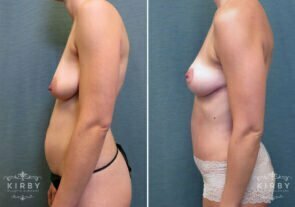 mommy-makeover-breast-lift-58c-left-kirby
