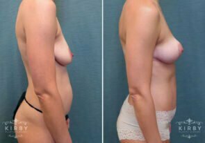 mommy-makeover-breast-lift-58c-right-kirby