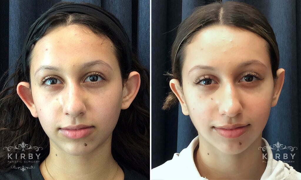 Ear Reshaping #G1794