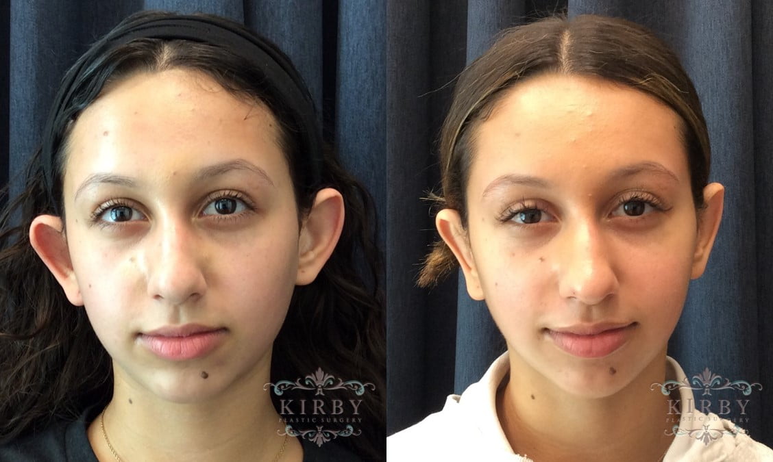 Dr. Kirby's patient before otoplasty, with protruding ears, and after otoplasty with a more proportional ear position and size