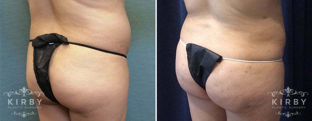 Brazilian Butt Lift G1643