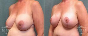 breast-implant-exchange-lift-166b-left-kirby