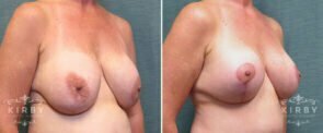 breast-implant-exchange-lift-166b-right-kirby