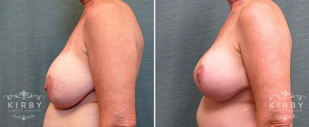 breast-implant-exchange-lift-166c-left-kirby