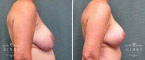 breast-implant-exchange-lift-166c-right-kirby