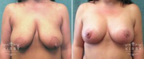 Breast Augmentation with Lift Patient G1153