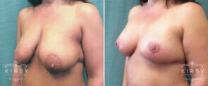 breast-lift-implants-153b-left-kirby