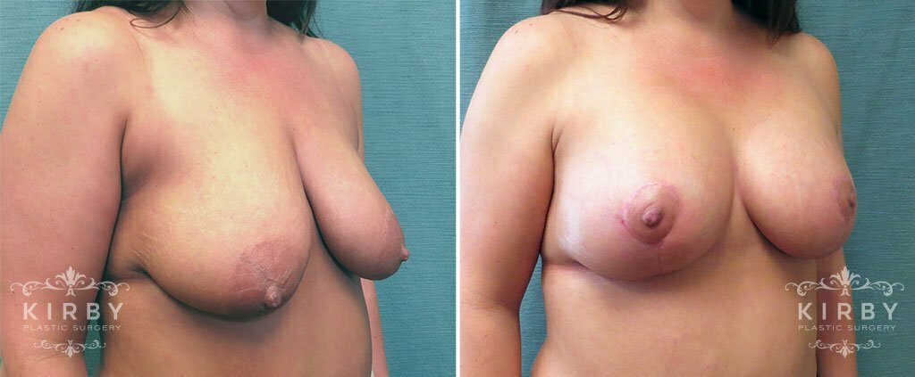 breast-lift-implants-153b-right-kirby