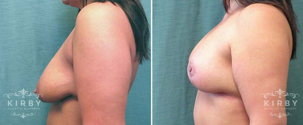 breast-lift-implants-153c-left-kirby