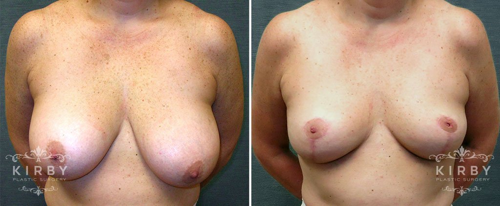 Breast Reduction G120