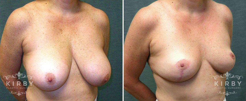 breast-reduction-G120b-kirby