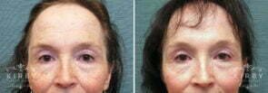 Brow Lift and Upper Eyelid Lift G110