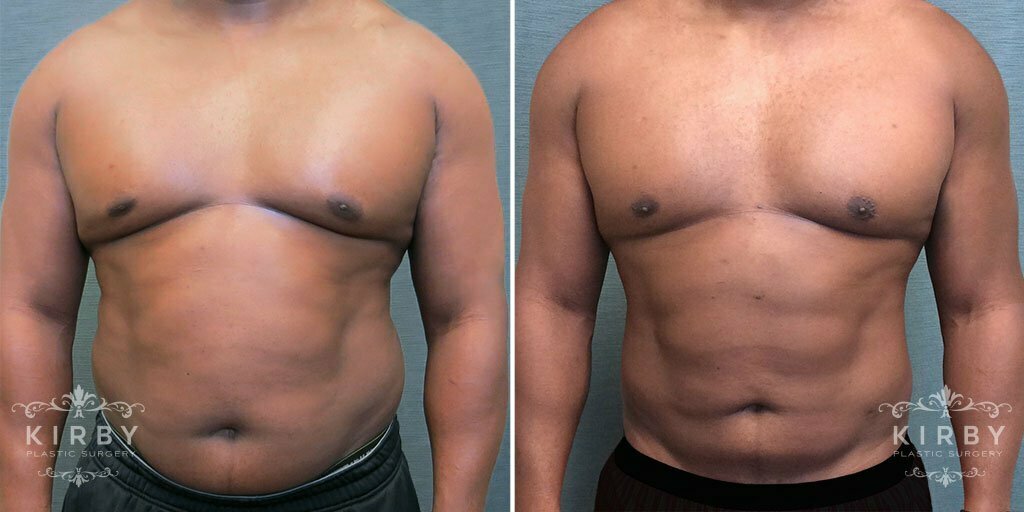 Male Liposuction G1212