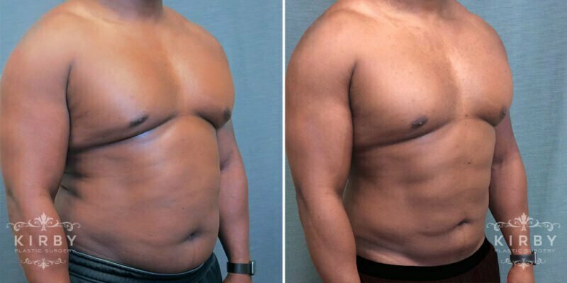 Photo of a male patient before (left) and after (right) liposuction.