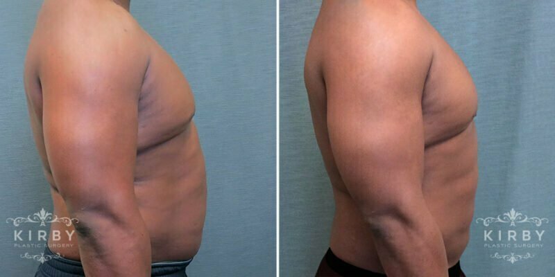 Photo of a male patient before (left) and after (right) liposuction.