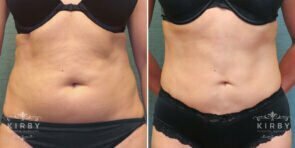 liposuction-46a-tummy-kirby
