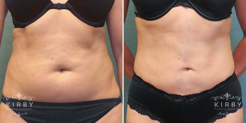 liposuction G146