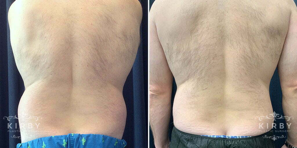 Male Liposuction G1679