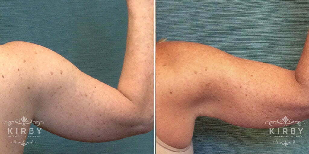 Arm Liposuction G1304