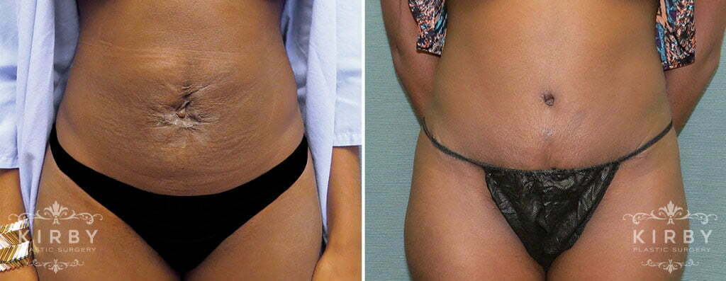 Mini Tummy Tuck G16