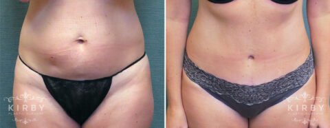 Female patient before and after tummy tuck Fort Worth
