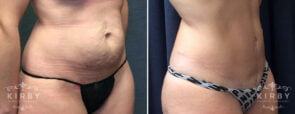 Tummy Tuck with Liposuction G1647