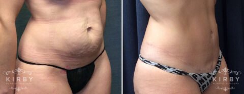 Right side view of female patient before and after tummy tuck Fort Worth